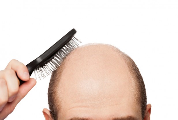 baldness-617x416